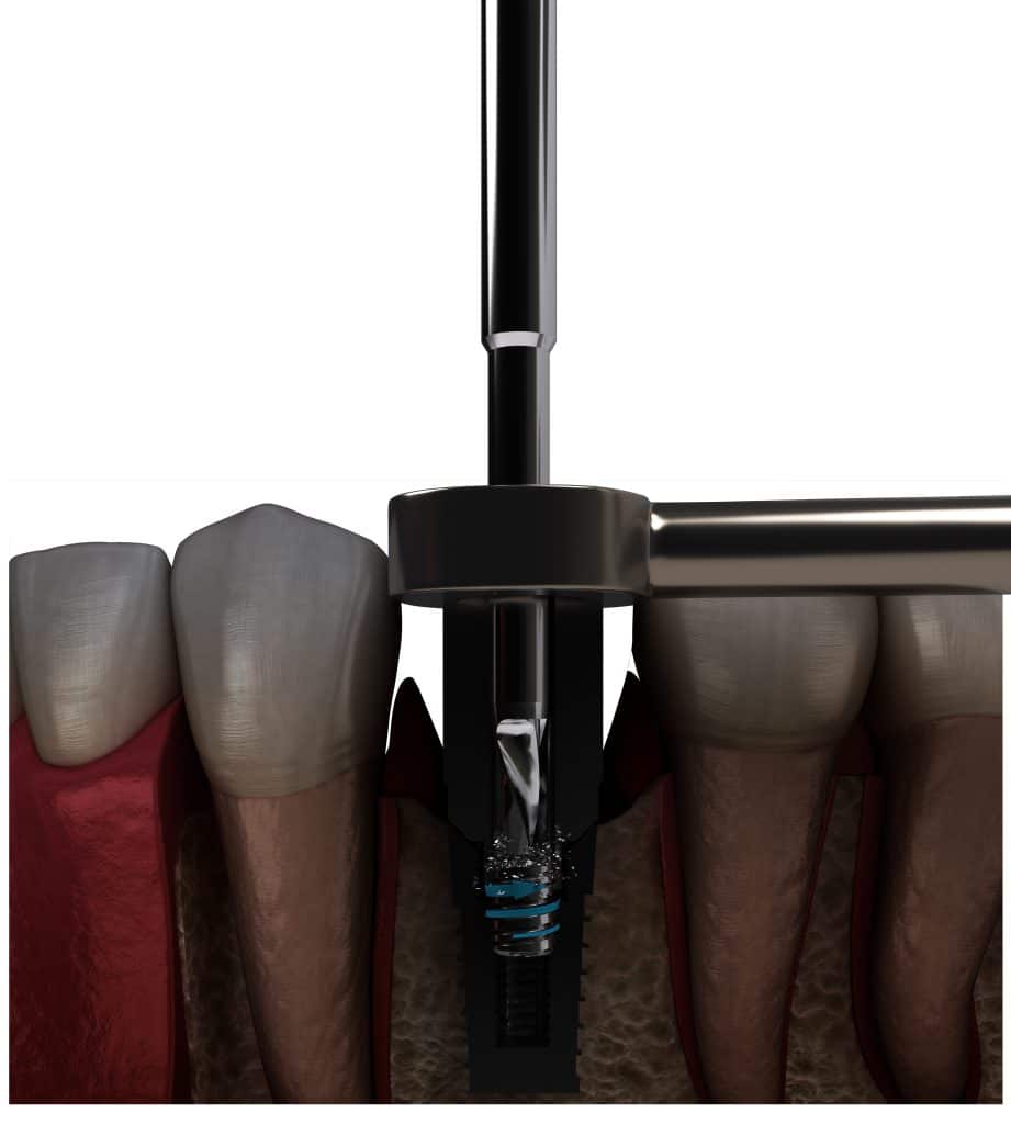 dental screw removal