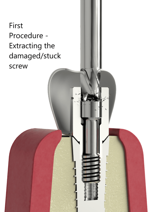 Dental Screw Removal A Revolution with Telcon's BHI Screw Removal Kit